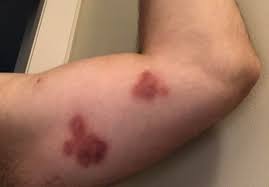 Bruises on the body