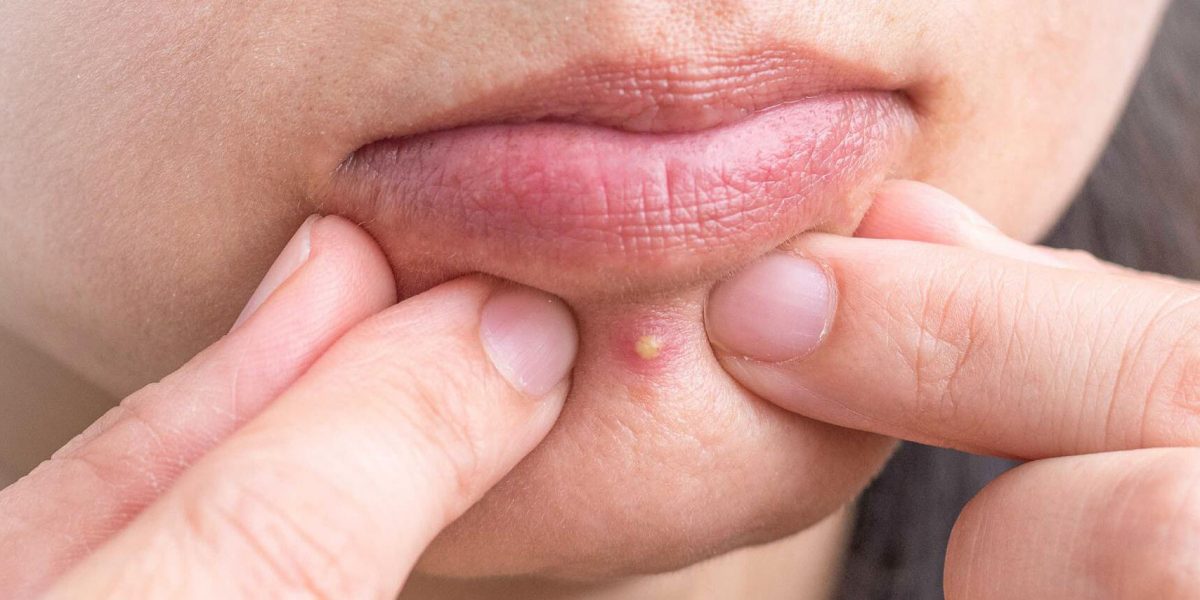 How to Cover a Pimple with Makeup