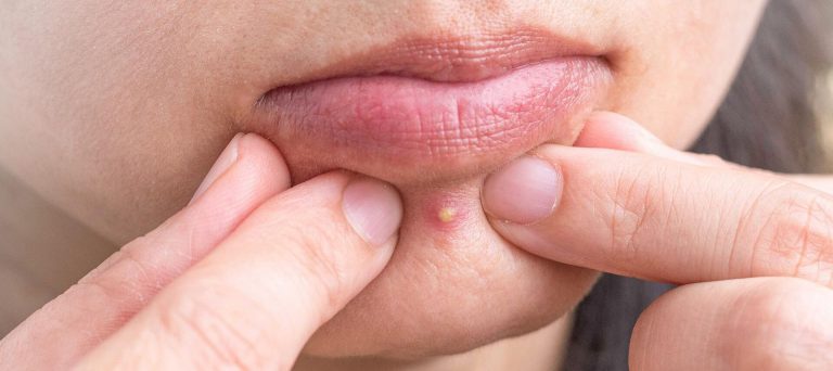 How to Cover a Pimple with Makeup