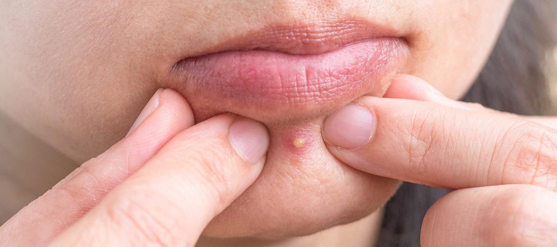 How to Cover a Pimple with Makeup