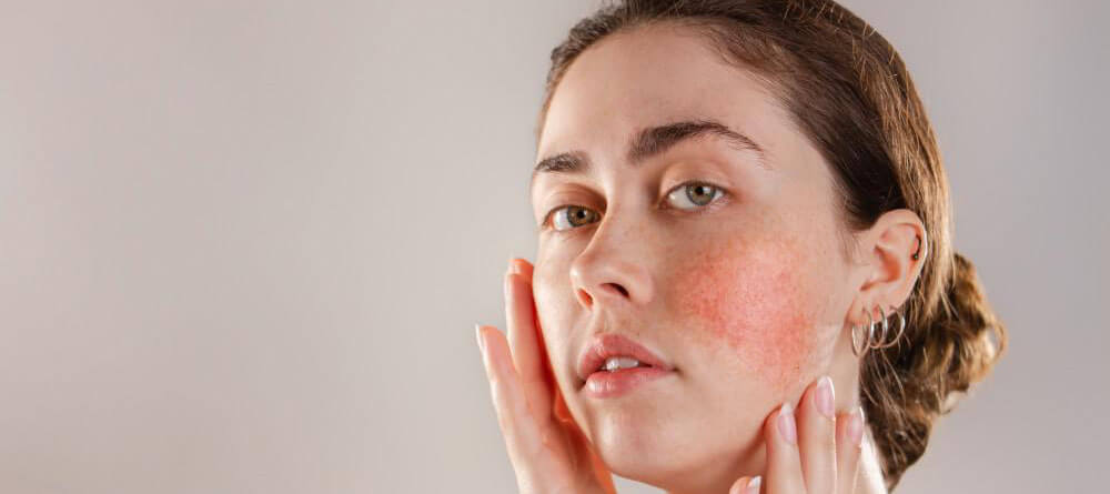 How to Remove the Redness of the Sun from the Face