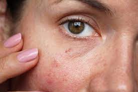 Protect the skin even when the redness has gone away