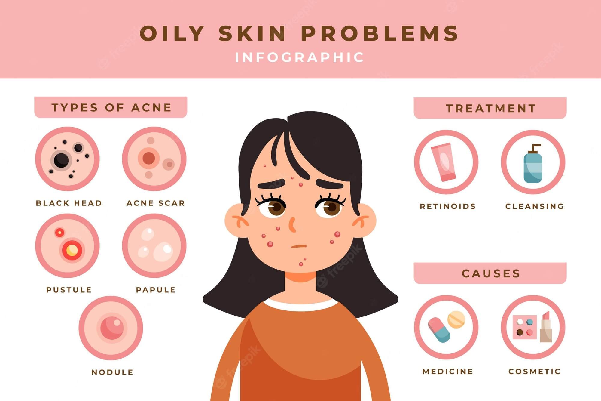 Best Soap For Oily Skin And Pimples infographics 