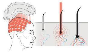 How does LLLT therapy help thin hair