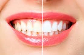 How is teeth whitening done?