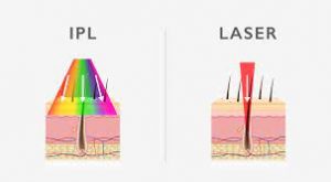 IPL or Laser