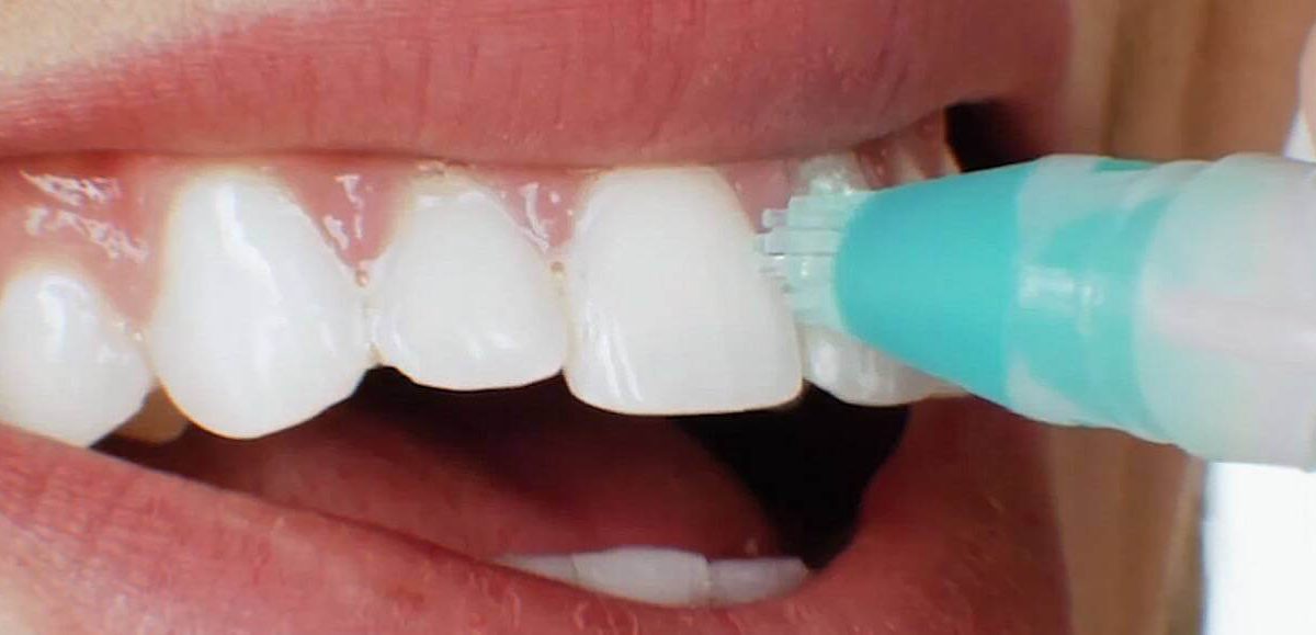 The Best Teeth Whitening Products Ever