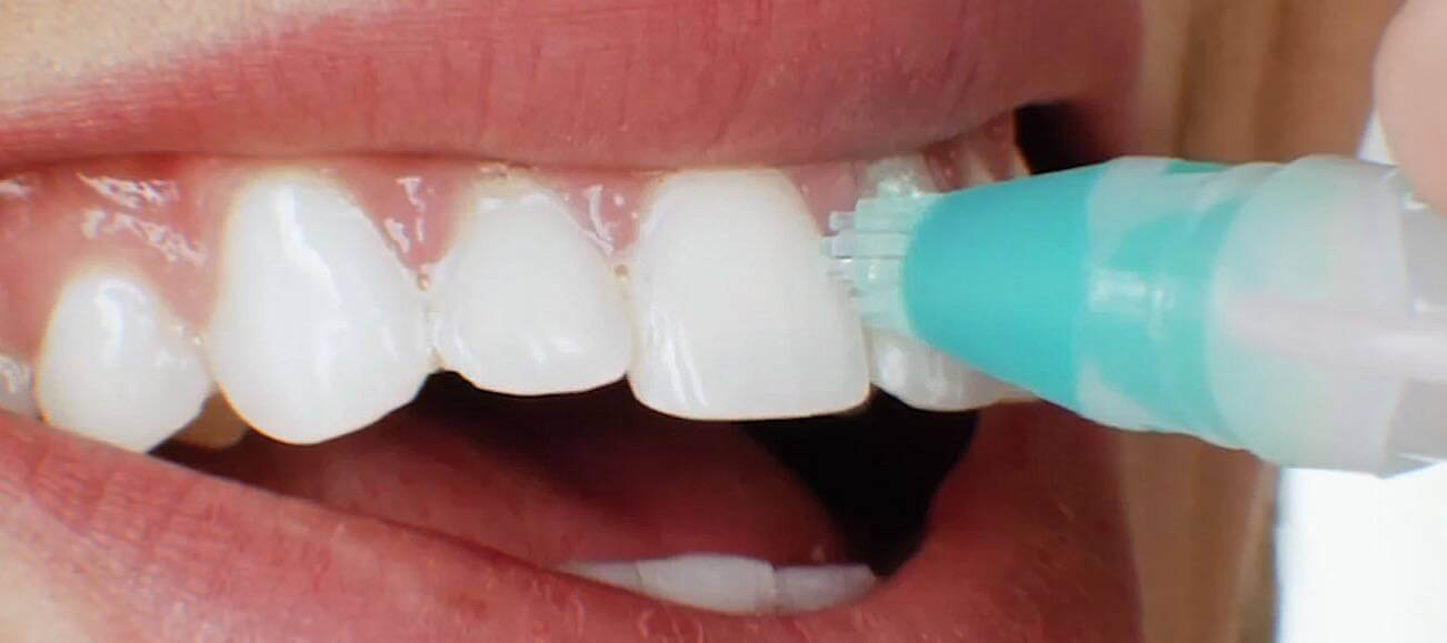 The Best Teeth Whitening Products Ever