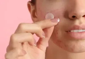 Tips for using patches to cure acne